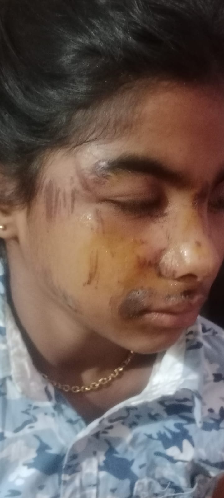 ऋषिकेश में आवारा सांडों का आतंक, ट्यूशन से लौट रही छात्रा गंभीर रूप से घायल